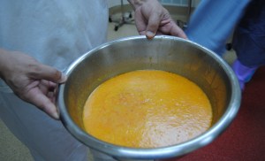 fat removed during liposuction procedure